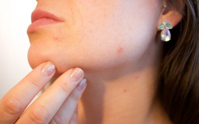 Reducing Breakout and Pimples: 6 Dermatology Tips